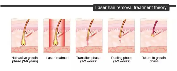 laser hair removal